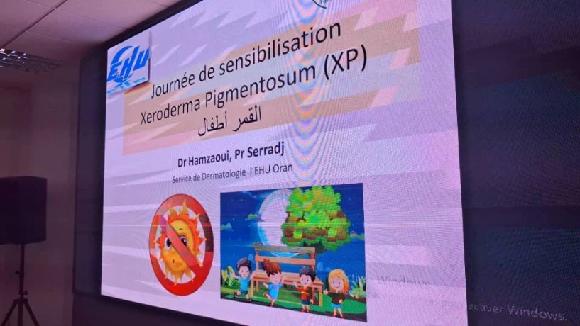 في مبادرة إنسانية لفائدة "أطفال القمر".....توزيع أقنعة وكريمات واقية بالمؤسسة الاستشفائية الجامعية  أول نوفمبر"